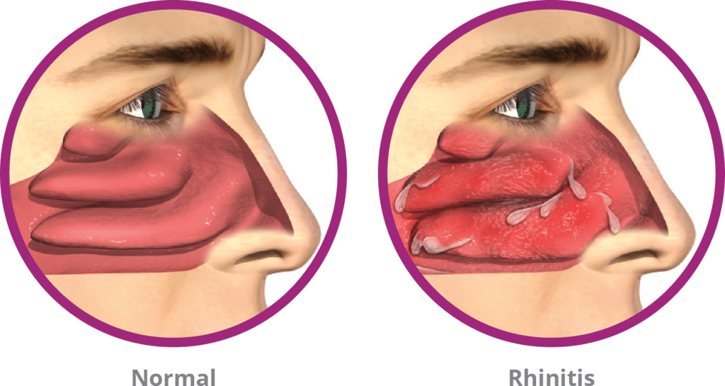 Normal vs Rhinitis